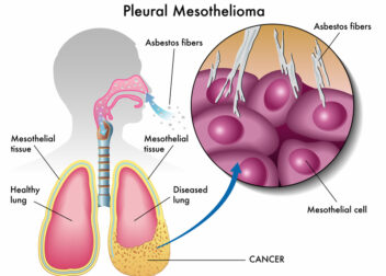 Mesothelioma