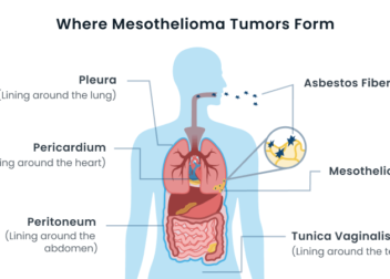 High Risk for Mesothelioma